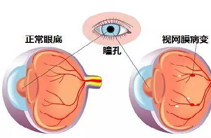 昆明眼科醫院，全家眼健康檢查，視網膜病變/脫落，高度近視