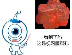 視網膜裂孔怎么治療
