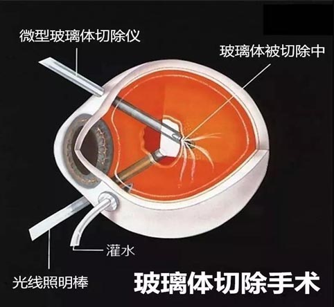 高度近視會視網膜脫落