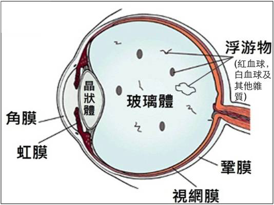 眼前有黑影飛來飛去，嚴重嗎？