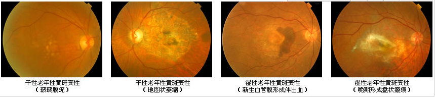 眼睛黃斑是什么？有什么危害