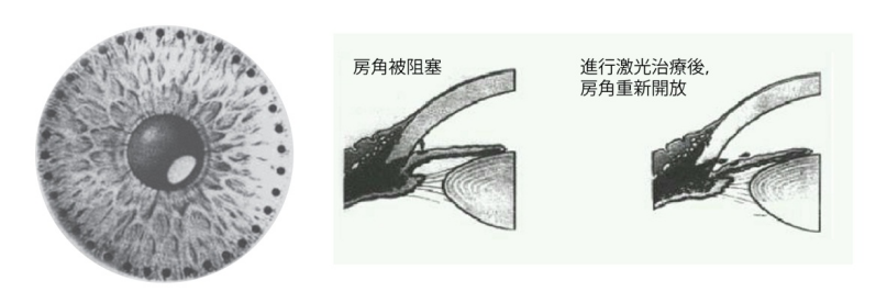 眼壓高就是青光眼嗎？