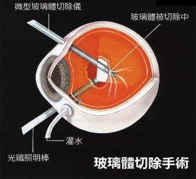 視網膜沒脫落完會失明嗎？
