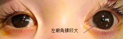 先天性青光眼手術風險大嗎