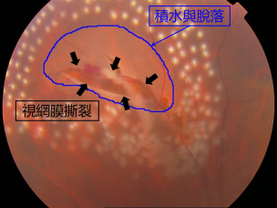 昆明哪家眼科醫(yī)院治視網(wǎng)膜脫落好？