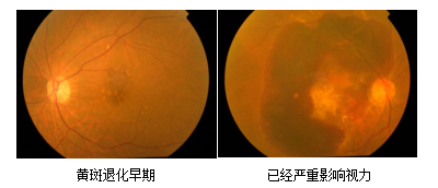 昆明哪家醫院可以治黃斑病變