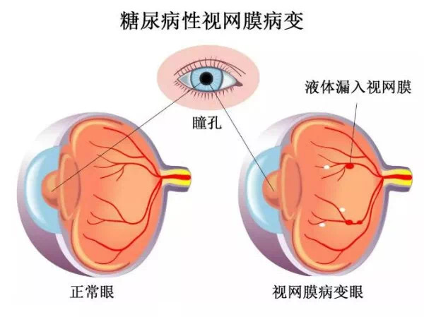 糖尿病視網膜病變嚴重嗎