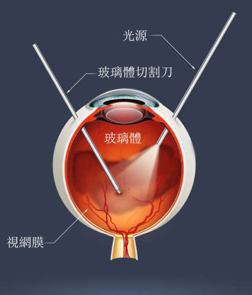 視網(wǎng)膜脫落癥狀有哪些？