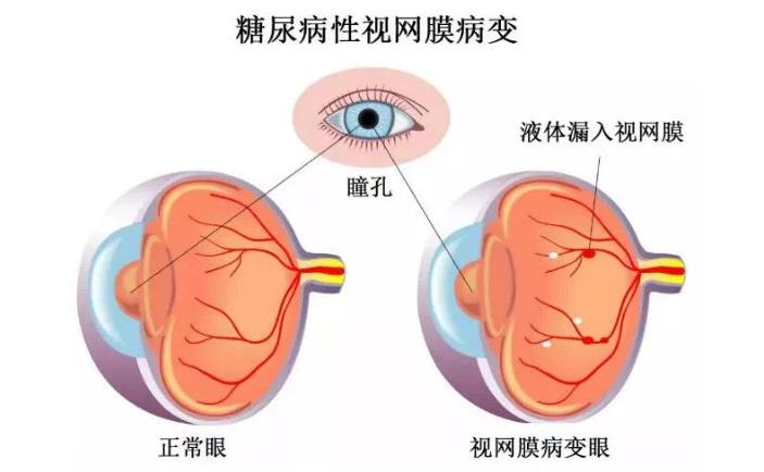 糖尿病視網(wǎng)膜病變怎么治療好得快？