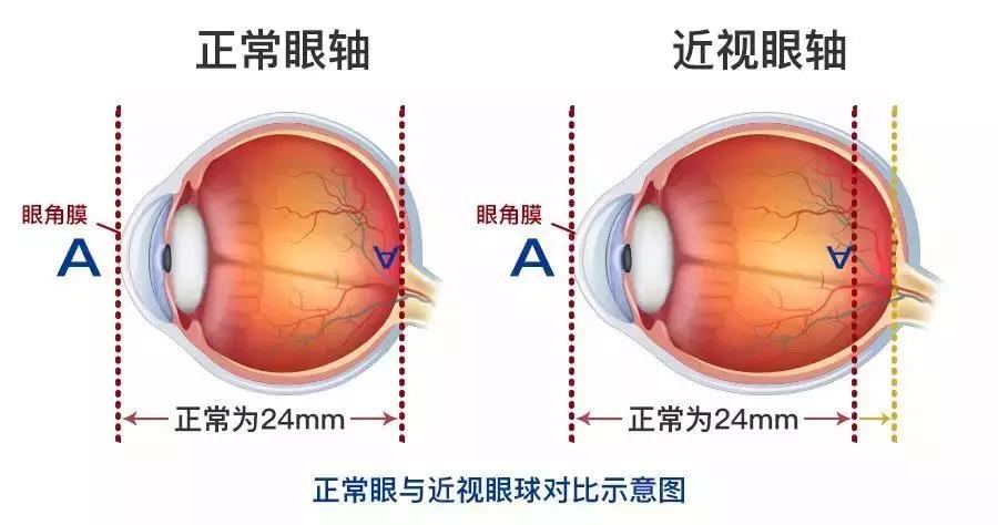 高度近視能做激光近視手術嗎？