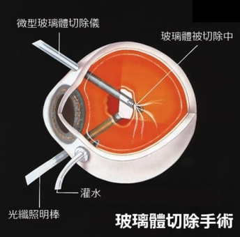 視網膜脫落在云南哪家醫院能治好？