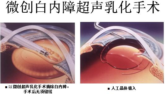 白內障手術醫?？梢詧箐N多少？