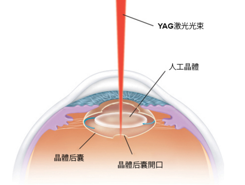白內障風險大嗎？會復發嗎？