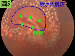 外傷引起的視網膜裂孔嚴重么？