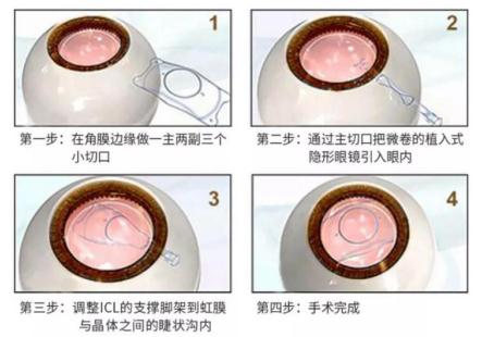 做全飛秒手術后能運動么？