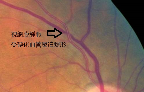 視網膜靜脈阻塞